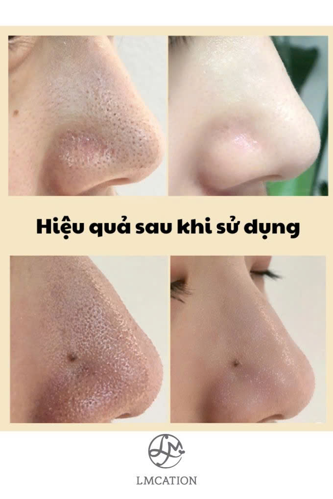 Keo Lột Mụn Cám Làm Mịn Da & Sạch Sâu Lỗ Chân Lông